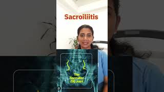 Sacroiliitis [upl. by Anitrebla]