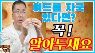 여드름 자국❗있다면❓꼭 알아두세요 여드름자국 여드름흉터 여드름흉터없애는방법 [upl. by Dorie]