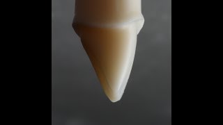 All Ceramic Crown Preparation for Emax and Zirconia [upl. by Solorac]