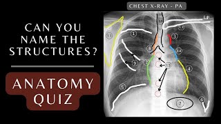 Chest Xray Anatomy Quiz Questions and Answers  Chest Xray Anatomy xray respiratory [upl. by Bury]