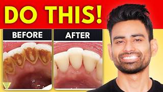 How to Remove Dental Plaque amp Prevent Cavities [upl. by Nananne414]