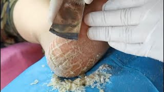 SO SATISFYING 7 mins Followup coming Look at the heel amp its dead skin Cracked heel treatment [upl. by Nnylrahc]