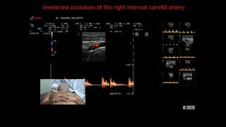 occlusione inveterata dellarteria carotide interna destra [upl. by Ayahs]