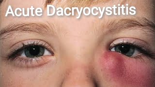 Lacrimal System  Acute and Chronic Dacryocystitis Part 2 [upl. by Sams]