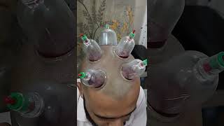 Unlocking the Secrets Hijama Cupping Therapy for Your Head alternativemedicine education [upl. by Sandor]