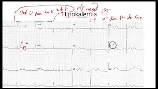 Hipokalemia EKG [upl. by Alaaj]