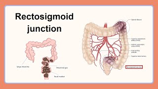 rectosigmoid junction [upl. by Koser]