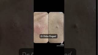 Mole removal 🥰👍شد rejuvenation الذكاءالاصطناعي fractionalco2laser [upl. by Taggart702]