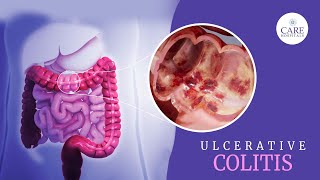 What is Ulcerative Colitis Causes Symptoms Diagnosis Treatment for Ulcerative Colitis [upl. by Ayikal]