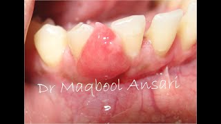 Excision of Gingival Epulis [upl. by Cheke283]