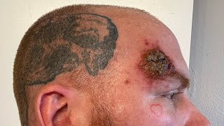 Week 5 Superficial Basal Cell Carcinoma Skin Cancer Aldara Treatment [upl. by Ajram]