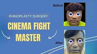 Transforming Features Rhinoplasty Surgery for a Cinema Fight Master [upl. by Etteniuq639]