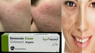 Dermovate Cream Uses  How to Treat Allergy Reaction at Home with Dermovate Cream  Benefits [upl. by Orhtej559]