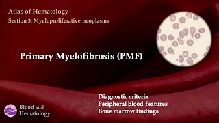 Primary Myelofibrosis PMF [upl. by Brinkema]