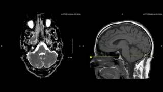 Unremarkable NonContrast Brain MRI Axial ADC Example 1 [upl. by Mata]