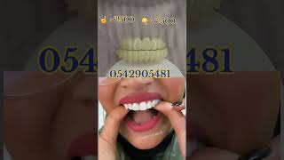 Hollywood smile tiktokvideo dz hollywoodsmile [upl. by Salas]