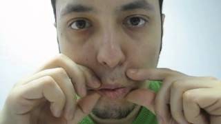 FACIAL PARESIS EXERCISE 6 AFTER ACOUSTIC NEUROMA SURGERY [upl. by Dulcinea]