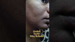 Day36 Using Tretinoin viralvideo tretinoin skincare shorts youtubeshorts [upl. by Cr]