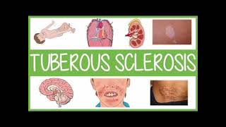 Tuberous sclerosis mrcpch Clinical [upl. by Aihsela]