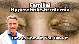 Familial Hypercholesterolemia  How to Know If You Have It [upl. by Oelc951]