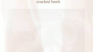 DIY remedy for Cracked Heels [upl. by Aitnis]