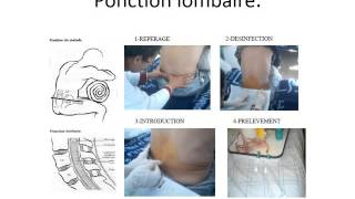 INFECTIOLOGIE Comment gérer un syndrome méningé 2014 Dr LAFSIHANE [upl. by Garett456]