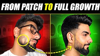 This is How I Treated a DANGEROUS Beard Patch 😰 Alopecia Areata Treatment  The Gabru Life [upl. by Button]