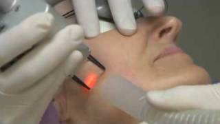 CO2 Fractionated Laser SkinResurfacing  DOT Therapy  deNovo Medical Group  Dallas [upl. by Aix]