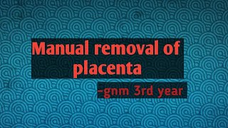 Manual removal of placenta note gnm 3rd year [upl. by Otanutrof]