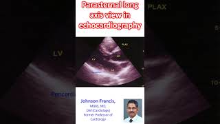 Parasternal long axis view in echocardiography [upl. by Anitirhc]