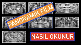 Panoramik Film Nasıl Okunur [upl. by Conlan361]