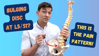 L5S1 Bulging Disc Pain Pattern Explained [upl. by Wrennie]