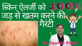 Skin allergy ko 100 khatam karne ki treatment at home How to cure skin allergy with 100 guarantee [upl. by Swayder]