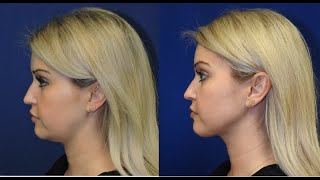 ChinNeck Liposuction Before  After  Nashville Plastic Surgeon [upl. by Kirre]