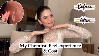 Chemical Peel Final Results😍  Cost amp Experience  Shilpa Chaudhary [upl. by Nereen]