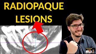 QUICK GUIDE How to Differentiate RADIOPAQUE lesions Periapical radiographs CBCT OPG sclerosis [upl. by Eesyak493]