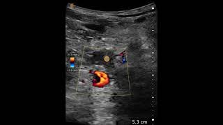 Popliteal Deep Venous Thrombosis  Ultrasound Image Interpretation [upl. by Arremat644]