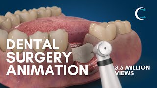 Dental Surgery Animation  Bone Grafting [upl. by Ahseile]