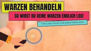 WARZEN BEHANDELN  So wirst du WARZEN endlich los [upl. by Orgalim97]