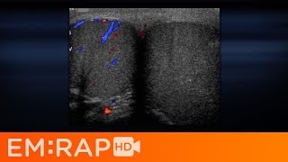 Ultrasound of Testicular Torsion [upl. by Anelegna]