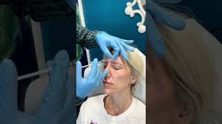 Xeomin Injections At Palm Beach  Xeomin Smart Toxin Injection shorts youtubeshort xeomin [upl. by Aicenra]