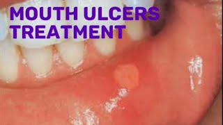 Drugs for mouth ulcers treatment pharmacist pharmacy [upl. by Aicillyhp]