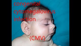 congenital cytomegalovirus infection CMV [upl. by Reteid]