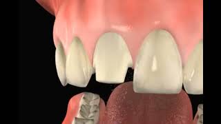 Crown Prep of Damaged Tooth  Pasadena Texas Dentist [upl. by Ylloj783]