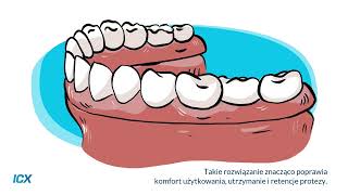 UZUPEŁNIENIE BRAKU UZĘBIENIA IMPLANTAMI ICX [upl. by Nyrahs]