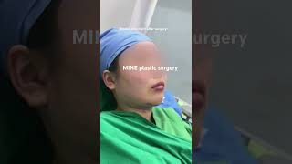 How your chin looks right after surgery surgery recovery mineplasticsurgery chin [upl. by O'Reilly203]