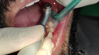 Lower left side first molar implant placement [upl. by Lanam]