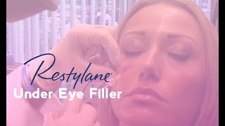 Restylane Under Eye Filler  Total Dermatology [upl. by Mindi]