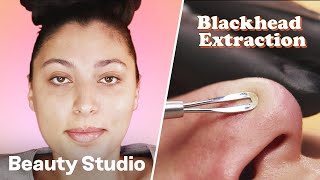 Blackhead Extraction Facial  Beauty Studio [upl. by Libbie530]