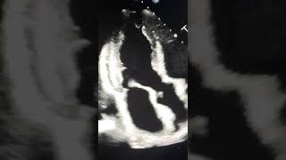 Echocardiography Apical 3 Chamber View With Color Doppler short [upl. by Enimajneb]